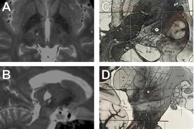 Successful Treatment of Holmes Tremor With Deep Brain Stimulation of the Prelemniscal Radiations